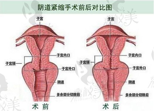 妇科紧缩手术值得做吗