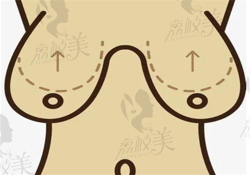 宋宝骥做男性乳腺手术怎么样