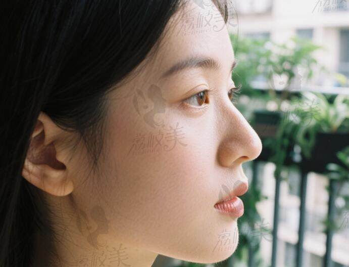 游远榕医生做鼻子实例