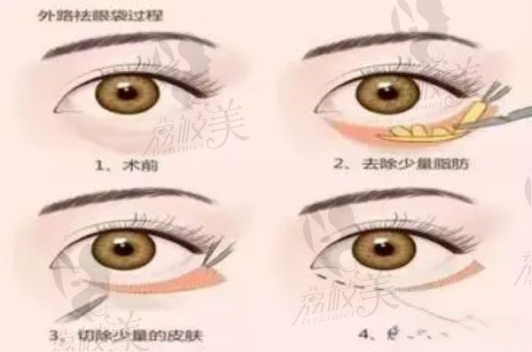 健丽去眼袋口碑怎么样