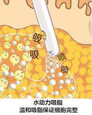 冯斌吸脂整形价格表