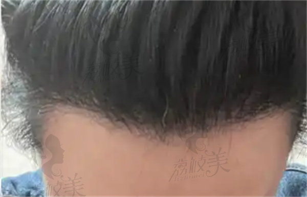 李会民美人尖种植
