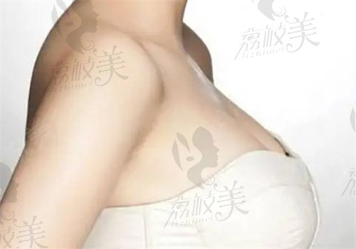 裴柄万医生隆胸自然吗