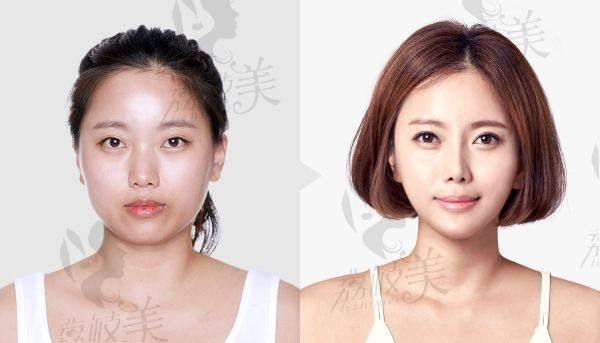 南京吴国平做颧骨内推怎么样