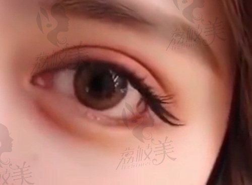 广州华美眼整形医生及价格