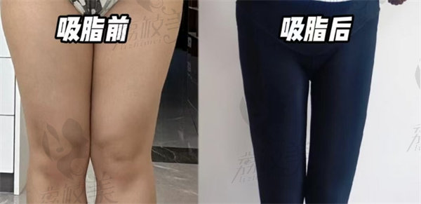德州凯琳翟春雷吸脂塑形