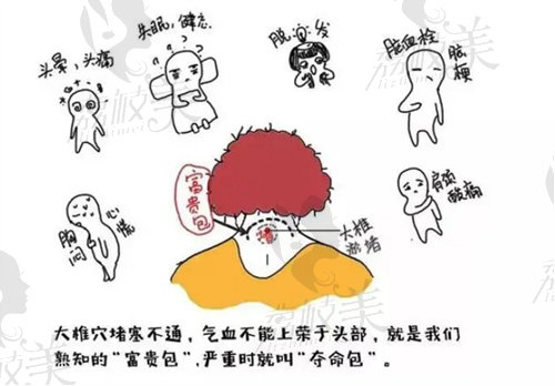 深圳源美朱志祥微创富贵包去除