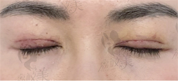 北京欧扬湾畔医疗美容诊所郝创做眼部修复