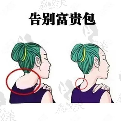 深圳曹孟君醫(yī)生的技術(shù)怎么樣