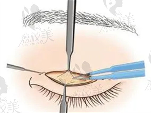 兰州亚韩整形医院做双眼皮价格