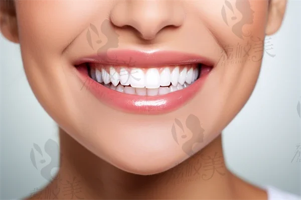 牙齿贴贴片美白的优势有哪些？