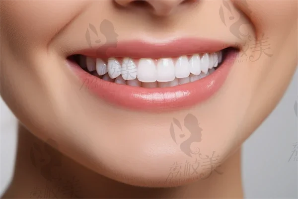 牙齿美白需要注意哪些误区？