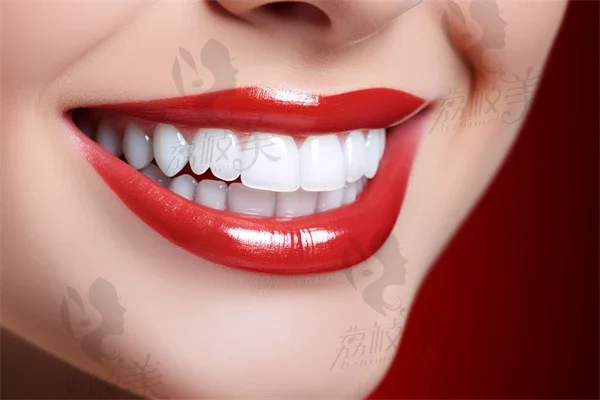 【洗牙】洗牙可以有效祛除牙菌斑吗？