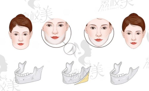 北京畫美醫(yī)療美容醫(yī)院王慧文大腿吸脂醫(yī)生優(yōu)勢