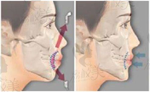 北京画美医疗美容医院在嘴角上扬术方面的特色优势