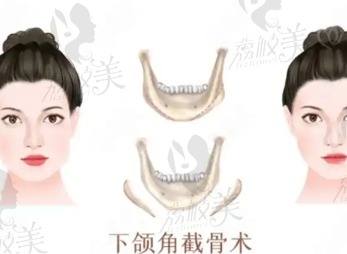 北京畫美醫(yī)療美容醫(yī)院王慧文大腿吸脂實(shí)例成效