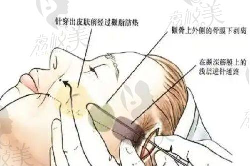 北京畫美醫(yī)療美容醫(yī)院王慧文大腿吸脂的注意事項(xiàng)