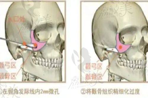 北京畫美醫(yī)療美容醫(yī)院王慧文大腿吸脂的未來發(fā)展趨勢