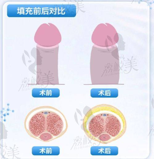 广州曙光医学美容玄峰院长8L液态骨雕技术6800元起——骨相抗衰一绝
