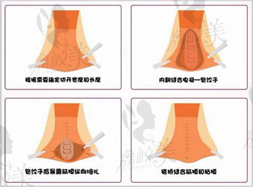 胸部整形