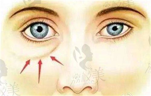 中山貝熙醫(yī)療美容醫(yī)院韓式懸眉術(shù)真人實(shí)例：見(jiàn)證眉部逆襲