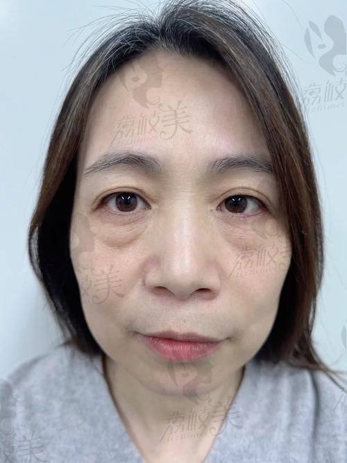 中山貝熙醫(yī)療美容醫(yī)院眼袋激光溶脂22800元起，高效去眼袋還原眼部年輕態(tài) 