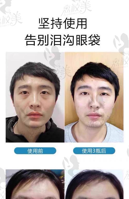 中山貝熙醫(yī)療美容醫(yī)院外切下臉袋(眶隔釋放)13800元起，重塑眼部年輕態(tài)效果驚人！ 