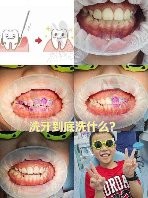 七、根管治疗价格参考