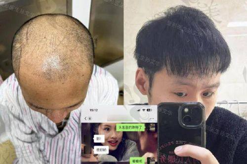 瑞丽诗植发：精致女性与艺术从业者的植发优选
