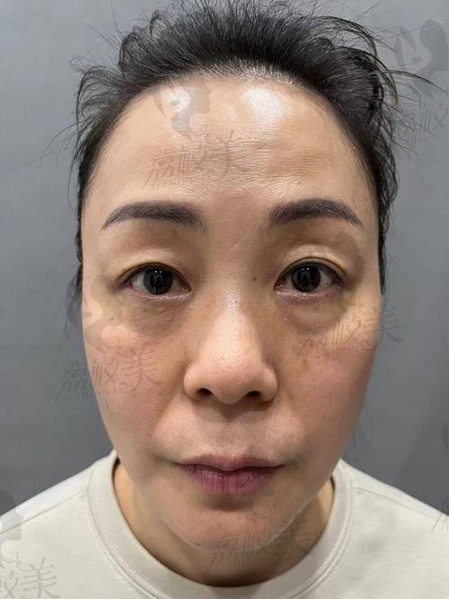 中山贝熙医疗美容医院眼袋光纤溶脂：优势特色大揭秘