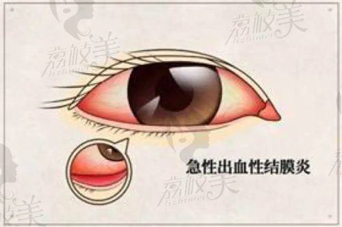 如何选择适合自己的佛山视力激光手术医院