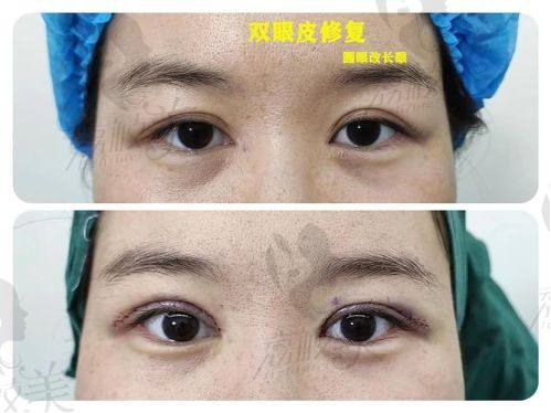 中山貝熙醫(yī)療美容醫(yī)院上瞼祛皮祛脂2800元起，重塑靈動眼眸，技術靠譜效果佳 