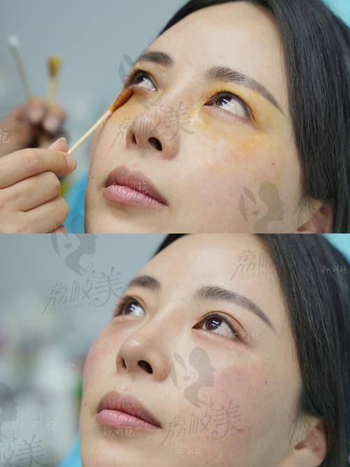 中山貝熙醫(yī)療美容醫(yī)院開內眼角3800元起，精細技藝打造靈動雙眸效果佳 