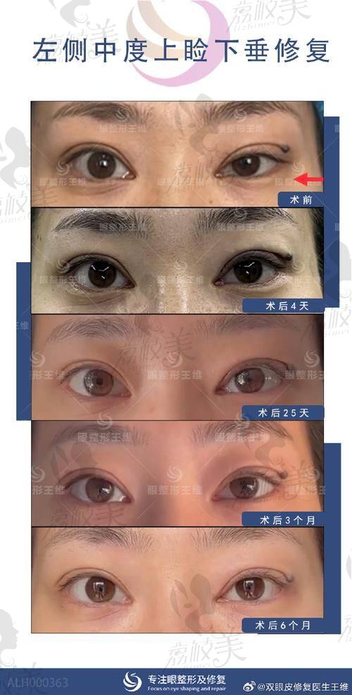 中山貝熙醫(yī)療美容醫(yī)院中度上瞼下垂矯正8800元起，專業(yè)技術重塑明亮雙眸獲好評 