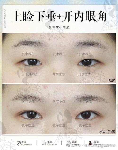 中山貝熙醫(yī)療美容醫(yī)院輕度上瞼下垂矯正5800元起，專業(yè)技術助您重塑明亮雙眸 