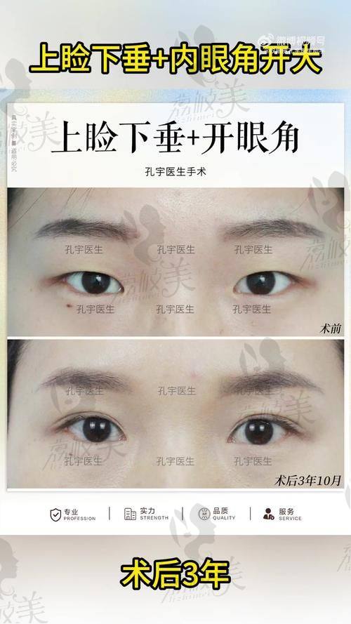 中山貝熙醫(yī)療美容醫(yī)院重度上瞼下垂矯正26800元起，專業(yè)技術重塑明亮雙眸 