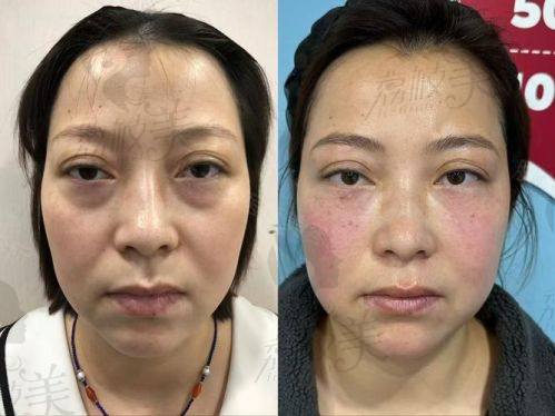 中山貝熙醫(yī)療美容醫(yī)院內路下瞼袋6800元起，無痕去袋重塑眼部年輕光彩 