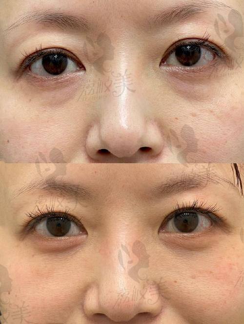8800 元的诱惑：中山贝熙外切下脸袋+下脸提升不可错过
