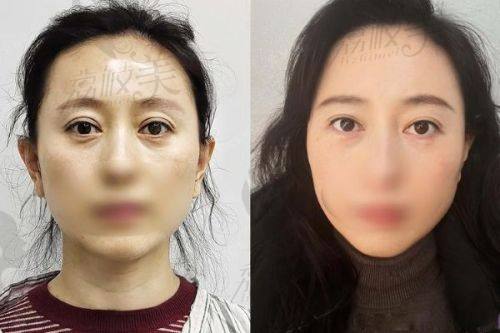 杭州双眼皮修复价格表：10大常见项目明细