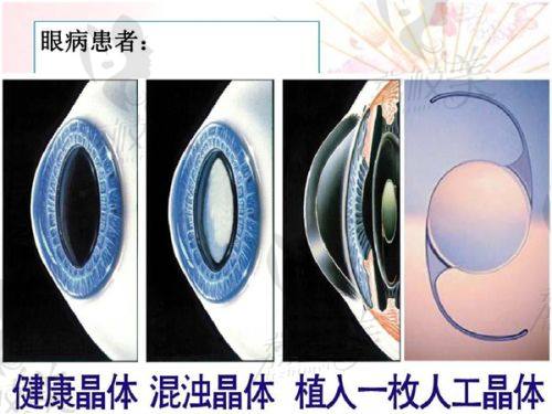 罗颖医生技术特点：
