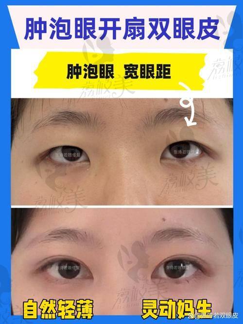 杭州双眼皮修复价格影响因素