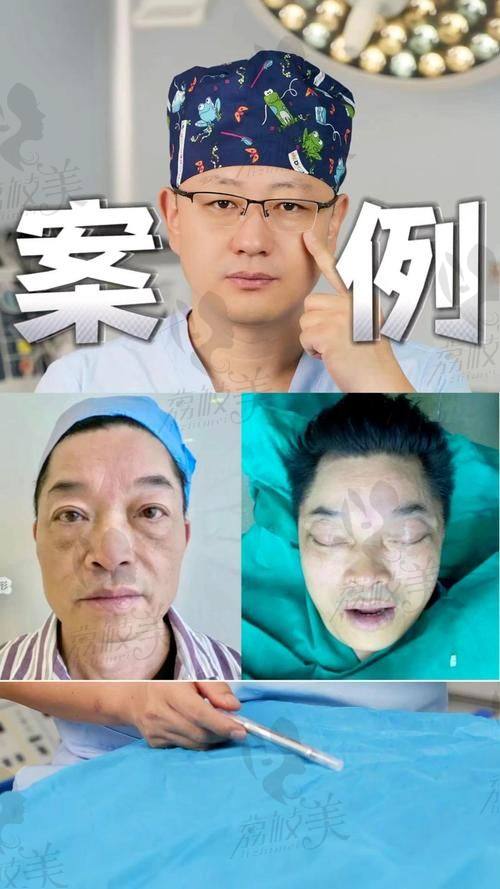 DGS四维拉皮 VS传统拉皮：谁更香？数据说话——