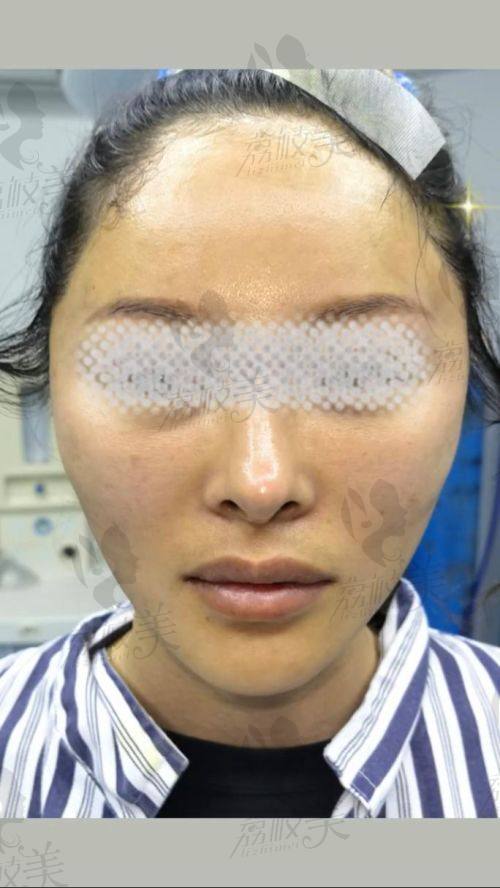 揭秘DGS四维复原术：和传统拉皮手术到底有啥不一样？