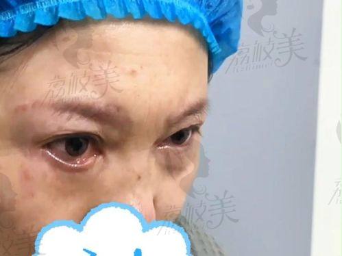 中山贝熙下睑童颜口碑爆棚