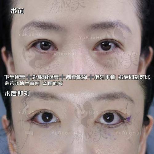 中山贝熙下睑童颜优势大揭秘