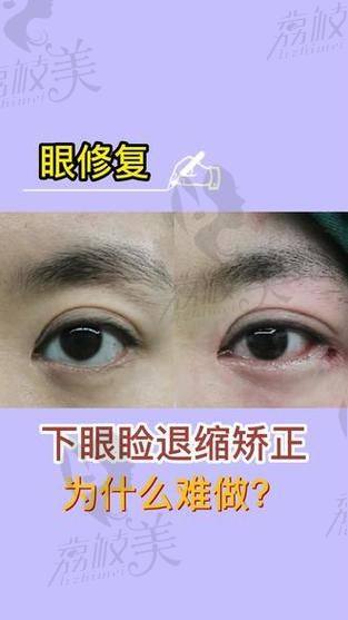 中山贝熙下睑童颜:15800 元的超值焕颜魔法