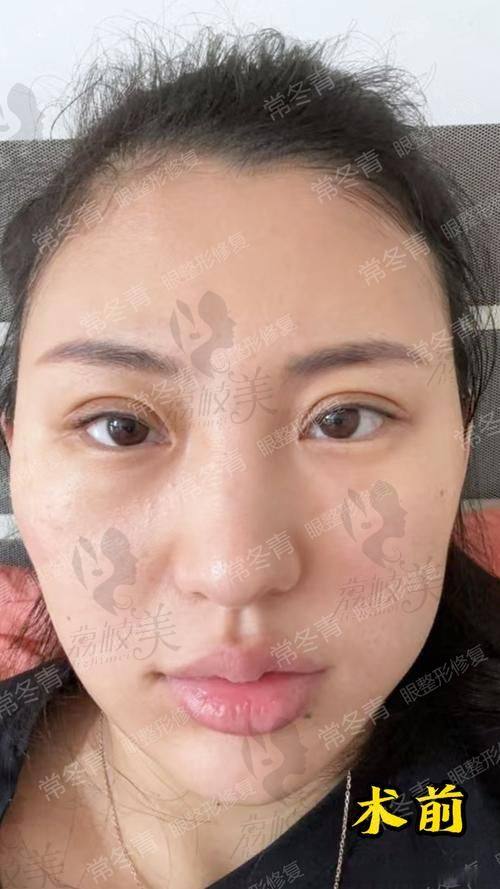 别再犹豫,加入中山贝熙下睑童颜之旅