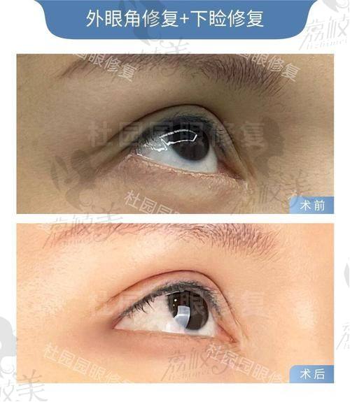 真人实例:中山贝熙下睑童颜的神奇见证