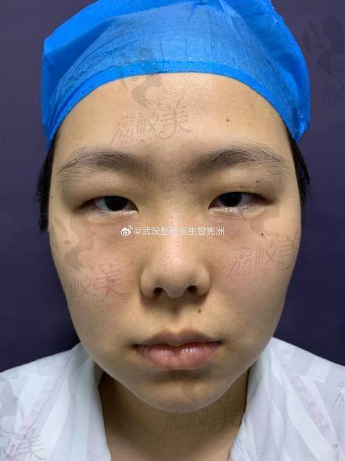 术后成效，惊艳到飞起
