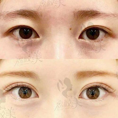邯郸美弧美润医生团队：打造 5800 - 16800 元双眼皮的魔法之手